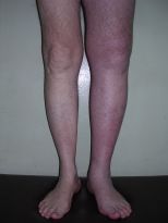 так выглядит тромбоз глубоких вен