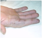 Пороки развития вен