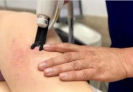 Лечение сосудистых звездочек лазером