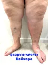 разрыв кисты Бейкера