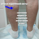 Разрыв кисты Бейкера