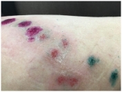 Аллергия на антисептик