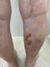Варикозный дерматит