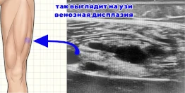 Схематичное изображение бедра и венозная дисплазия на узи