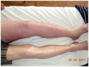 Тромбоз глубоких вен