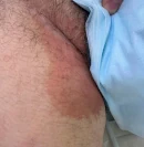 паховая эпидермофития