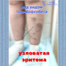 узловатая эритема