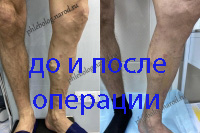 Лазерное лечение варикоза