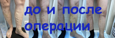 Лазерное лечение варикоза