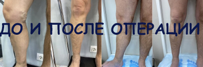 Результат после лазерной коагуляции вен и минифлебэктомии
