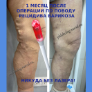 Результат лазерной операции при варикозе