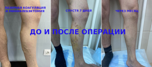 До и после лазерного лечения варикоза