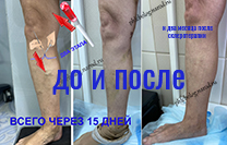 После лазерной коагуляции и минифлебэктомии, а также склеротерапии после операции