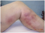 Поверхностный тромбофлебит