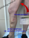 Тромбофлебит большой подкожной вены