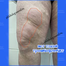 тромбофлебит поверхностных вен