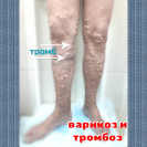 тромбофлебит поверхностных вен