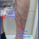 тромбоз глубоких и поверхностных вен