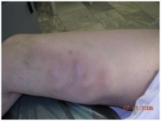 Выраженное воспаление при тромбофлебите