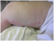 Флебит не варикозной вены