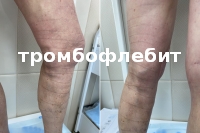 Поверхностный тромбофлебит