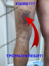 Тромбофлебит поверхностной вены слева