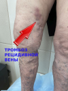 Тромбофлебит и рецидив варикозной болезни