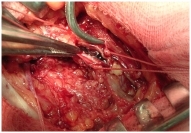 Поверхностный тромбофлебит