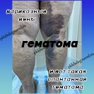 Разрыв вены при варикозе