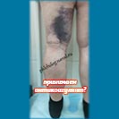 Осложнение антикоагулянтной терапии