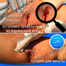 Кровотечение из варикозной вены