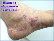 Герпетическая инфекция стопы