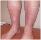 Хроническая венозная недостаточность