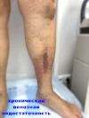 Хроническая венозная недостаточность