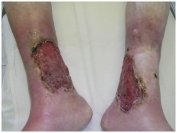 Повязка Унна