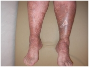 Хроническая венозная недостаточность