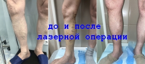 После лазерной операции