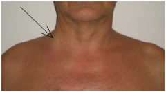 Тромбоз яремной вены