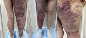 Стрии или растяжки кожи, а вовсе не вены