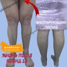 Ковид-19 и тромбоз