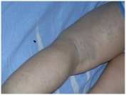 Порок развития вен