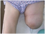 Тромбоз глубоких вен