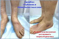 Тромбоз глубоких и поверхностных вен