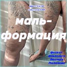 Венозная мальформация