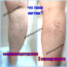 Меттинг после склеротерапии