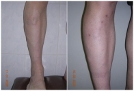 После минифлебэктомии