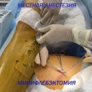 Местная анестезия при операции на венах