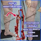 Вены после минифлебэктомии