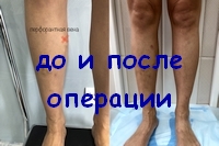 Двухнедельный результат операции по поводу варикоза