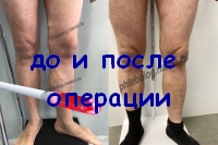 Результат после лазерной операции на венах